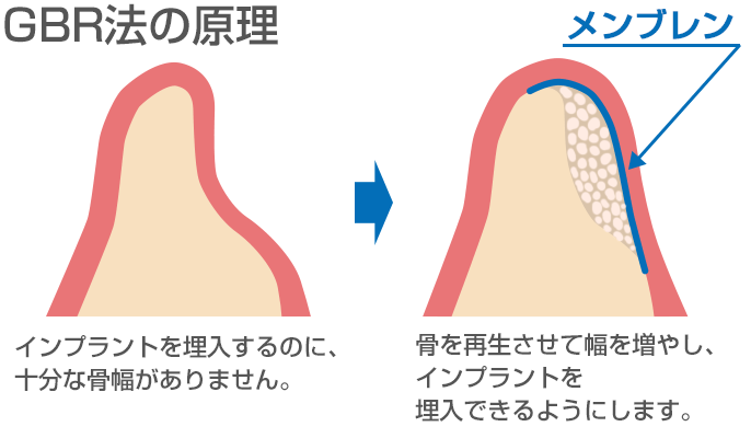 gbr法の原理